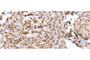 Immunohistochemistry of paraffin-embedded Human prost at e cancer tissue using ZFYVE16 Polyclonal Antibody at dilution of 1:60(x200)