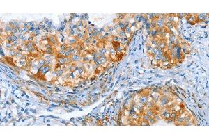 Immunohistochemistry of paraffin-embedded Human cervical cancer tissue using AIP Polyclonal Antibody at dilution 1:80 (AIP anticorps)