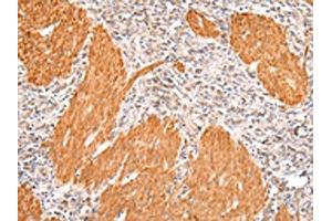 The image on the left is immunohistochemistry of paraffin-embedded Human gastric cancer tissue using ABIN7191067(IKZF4 Antibody) at dilution 1/20, on the right is treated with synthetic peptide. (IKZF4 anticorps)