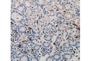 IHC-P analysis of stomach cancer tissue, with DAB staining. (Midkine anticorps  (AA 22-143))