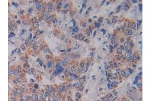 Detection of SHMT2 in Human Colorectal cancer Tissue using Polyclonal Antibody to Serine Hydroxymethyltransferase 2, Mitochondrial (SHMT2)