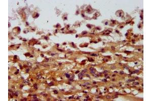 IHC image of ABIN7148018 diluted at 1:400 and staining in paraffin-embedded human melanoma performed on a Leica BondTM system. (COPG2 anticorps  (AA 676-823))