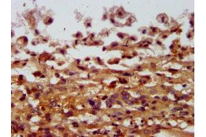 IHC image of ABIN7148018 diluted at 1:400 and staining in paraffin-embedded human melanoma performed on a Leica BondTM system. (COPG2 anticorps  (AA 676-823))