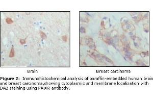 Immunohistochemical analysis of paraffin-embedded human brain (left) and breast carcinoma (right), showing cytoplasmic and membrane localization using PAR4 antibody with DAB staining. (F2RL3 anticorps  (AA 1-330))