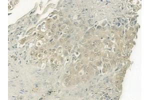 ABIN6264131 and ABIN6277486 at 1/100 staining human lung squamous cell carcinoma by IHC-P. (PELP1 anticorps  (Internal Region))