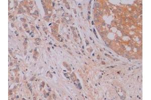 Detection of β-catenin in Human Breast cancer Tissue using Monoclonal Antibody to Beta Catenin (β-catenin)