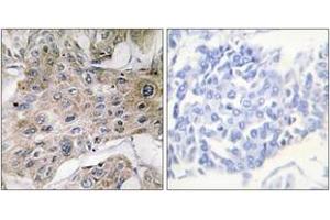 Immunohistochemistry analysis of paraffin-embedded human breast carcinoma tissue, using COX7S/A2 Antibody. (COX7S/A2 (AA 1-50) anticorps)