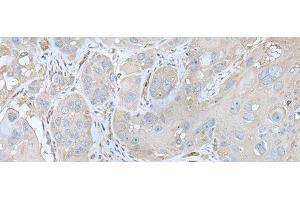 Immunohistochemistry of paraffin-embedded Human esophagus cancer tissue using USO1 Polyclonal Antibody at dilution of 1:30(x200) (USO1 anticorps)
