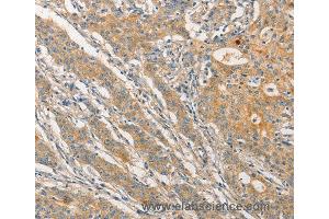 Immunohistochemistry of Human esophagus cancer using STAM Polyclonal Antibody at dilution of 1:40 (STAM anticorps)