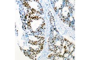 Immunohistochemical analysis of CDK2 staining in human colon cancer formalin fixed paraffin embedded tissue section. (CDK2 anticorps  (Center))
