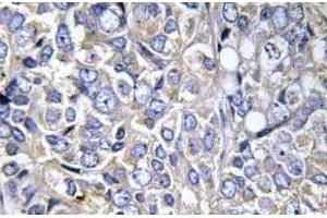 Immunohistochemistry analysis of Cortactin antibody in paraffin-embedded human prostate carcinoma tissue. (Cortactin anticorps  (pTyr421))