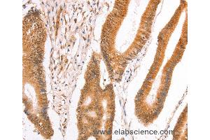 Immunohistochemistry of Human thyroid cancer using TAX1BP1 Polyclonal Antibody at dilution of 1:40 (TAX1BP1 anticorps)