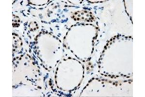 Immunohistochemical staining of paraffin-embedded Adenocarcinoma of colon tissue using anti-RALBP1mouse monoclonal antibody. (RALBP1 anticorps)