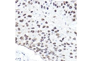 Immunohistochemistry of paraffin-embedded human lung cancer using [KO Validated] NBS1/NBS1/NBN Rabbit pAb (ABIN1681204, ABIN3015326, ABIN3015327 and ABIN5663771) at dilution of 1:50 (40x lens).
