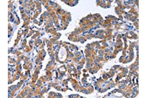 The image on the left is immunohistochemistry of paraffin-embedded Human thyroid cancer tissue using ABIN7129821(IGSF10 Antibody) at dilution 1/50, on the right is treated with fusion protein. (IGSF1 anticorps)