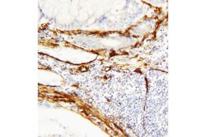 Anti-Caveolin-1 antibody, IHC(P) IHC(P): Human Mammary Cancer Tissue