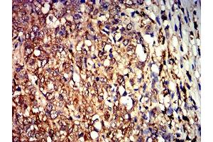 Immunohistochemical analysis of paraffin-embedded breast cancer tissues using ALDOA mouse mAb with DAB staining. (ALDOA anticorps  (AA 9-145))