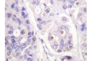 Immunohistochemical analysis of human breast carcinoma tissue (Formalin- fixed Paraffin-embedded) using CDC16 / APC6 antibody . (CDC16 anticorps)
