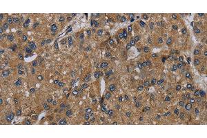 Immunohistochemistry of paraffin-embedded Human liver cancer tissue using NDUFS6 Polyclonal Antibody at dilution 1:50 (NDUFS6 anticorps)