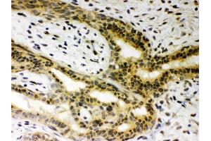 Anti-SIRT6Picoband antibody, (ABIN3043435), IHC(P)IHC(P): Human Mammary Cancer Tissue (SIRT6 anticorps  (AA 14-180))