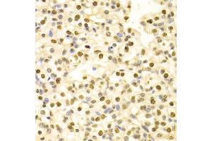 Immunohistochemistry of paraffin-embedded human kidney cancer using HDGF Antibody. (HDGF anticorps  (AA 1-240))