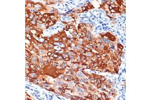Immunohistochemistry of paraffin-embedded human lung cancer using IL13R Rabbit mAb (ABIN7267986) at dilution of 1:100 (40x lens). (IL13 Receptor alpha 1 anticorps)