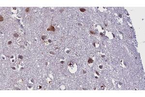 ABIN6275839 at 1/100 staining Human brain cancer tissue by IHC-P.