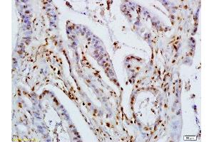 Formalin-fixed and paraffin embedded human colon carcinoma labeled with Rabbit Anti KLF4 Polyclonal Antibody, Unconjugated  at 1:200 followed by conjugation to the secondary antibody and DAB staining (KLF2/4 anticorps  (AA 415-513))
