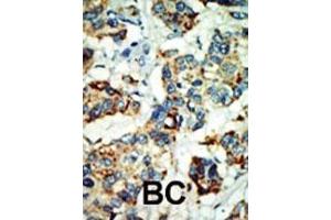 Formalin-fixed and paraffin-embedded human cancer tissue reacted with the primary antibody, which was peroxidase-conjugated to the secondary antibody, followed by AEC staining.