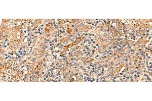 Immunohistochemistry of paraffin-embedded Human liver cancer tissue using DNAJC14 Polyclonal Antibody at dilution of 1:70(x200) (DNAJC14 anticorps)
