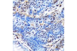 Immunohistochemistry of paraffin-embedded human colon carcinoma using CTIP1/BCL11A Rabbit mAb  at dilution of 1:100 (40x lens). (BCL11A anticorps)