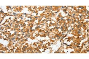 Immunohistochemistry of paraffin-embedded Human thyroid cancer tissue using ANXA9 Polyclonal Antibody at dilution 1:30 (Annexin A9 anticorps)