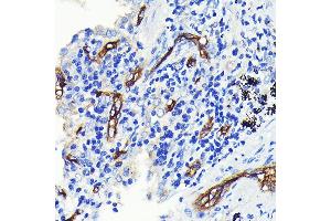 Immunohistochemistry of paraffin-embedded human lung cancer using CD34 Rabbit mAb (ABIN7266187) at dilution of 1:100 (40x lens).