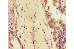 Immunohistochemistry of paraffin-embedded human lung cancer using ABIN7145002 at dilution of 1:100 (DHX33 anticorps  (AA 116-357))