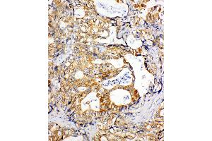 Anti-SDHC antibody, IHC(P) IHC(P): Human Gastric Cancer Tissue (SDHC anticorps  (N-Term))