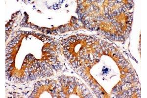 IHC-P: Integrin alpha 1 antibody testing of human intestinal cancer tissue (Integrin alpha 1 anticorps  (C-Term))