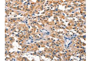 The image on the left is immunohistochemistry of paraffin-embedded Human thyroid cancer tissue using ABIN7190518(DUSP2 Antibody) at dilution 1/30, on the right is treated with synthetic peptide. (DUSP2 anticorps)