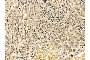 FAK Mouse Monoclonal Antibody at 1/100 staining human gastric cancer by IHC-P.