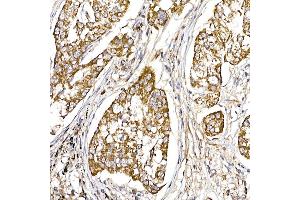 Immunohistochemistry of paraffin-embedded human lung cancer using UQCRH Rabbit mAb (ABIN7271126) at dilution of 1:50 (40x lens). (UQCRH anticorps)