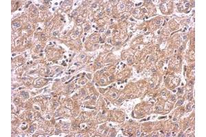 IHC-P Image mTOR antibody detects FRAP1 protein at cytosol on human hepatoma by immunohistochemical analysis. (MTOR anticorps  (C-Term))