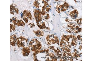 Immunohistochemistry of Human thyroid cancer using HINT2 Polyclonal Antibody at dilution of 1:50 (HINT2 anticorps)