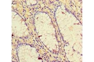 Immunohistochemistry of paraffin-embedded human colon cancer using ABIN7154947 at dilution of 1:100