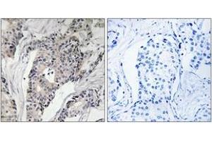 Immunohistochemistry analysis of paraffin-embedded human breast carcinoma, using THBS4 Antibody. (THBS4 anticorps  (AA 561-610))