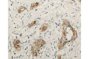 ABIN6276910 at 1/100 staining human lung tissue sections by IHC-P. (Surfactant Protein C anticorps  (N-Term))
