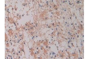 Detection of Hepc in Human Glioma Tissue using Monoclonal Antibody to Hepcidin (Hepc)