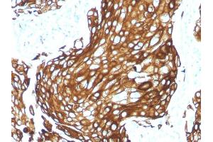Formalin-fixed, paraffin-embedded human Lung Carcinoma stained with CK LMW Rabbit Recombinant Monoclonal Antibody (KRTL/1577R). (Recombinant Keratin 77 anticorps)