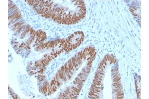 Formalin-fixed, paraffin-embedded human Colon Carcinoma stained with CDX2 Rabbit Recombinant Monoclonal Antibody (CDX2/2951R). (Recombinant CDX2 anticorps  (AA 150-249))