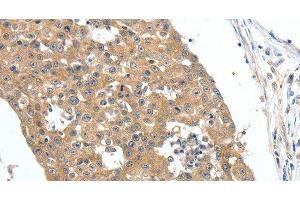 Immunohistochemistry of paraffin-embedded Human breast cancer tissue using FSHR Polyclonal Antibody at dilution 1:70 (FSHR anticorps)