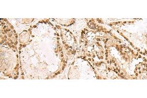 Immunohistochemistry of paraffin-embedded Human thyroid cancer tissue using KRR1 Polyclonal Antibody at dilution of 1:50(x200) (KRR1 anticorps)