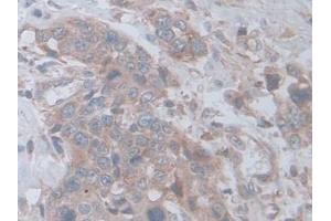 Detection of D2HGDH in Human Prostate cancer Tissue using Polyclonal Antibody to D2-Hydroxyglutarate Dehydrogenase (D2HGDH)